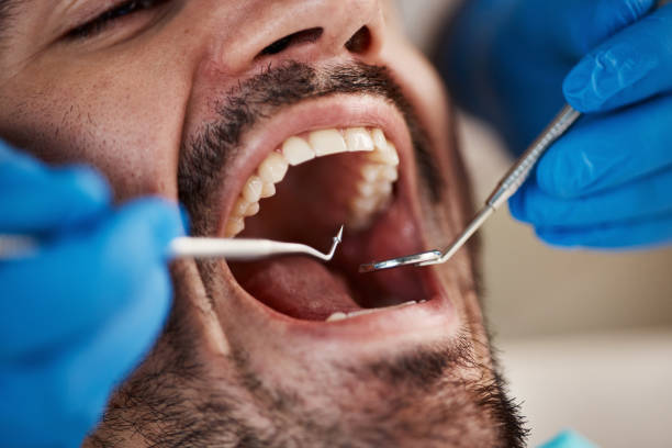 Best Emergency Wisdom Teeth Removal in Hortonville, WI