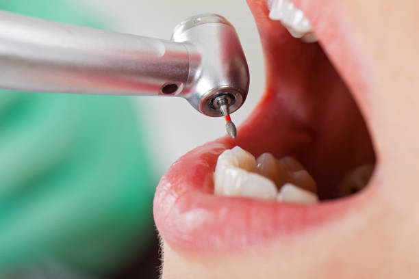 Best Emergency Tooth Extraction in Hortonville, WI